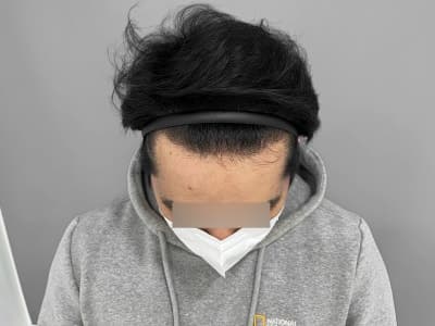 모발이식과 모낭줄기세포 치료 6개월 실제 사례중 치료후 사진
