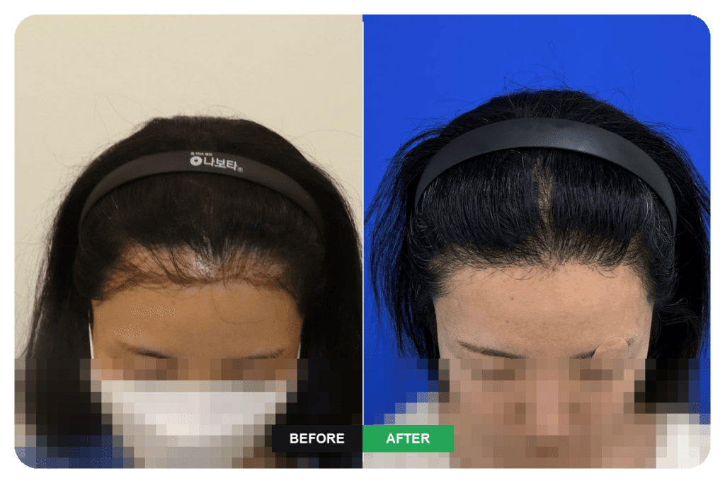 Before and after female hairline revision surgery