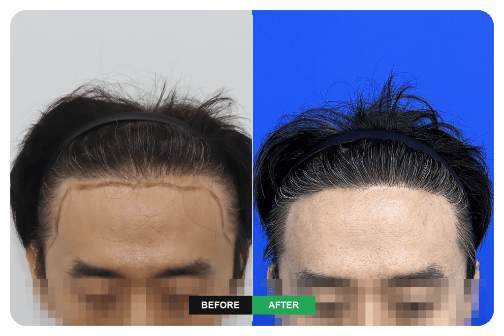 Before and after hair transplant revision surgery following forehead reduction