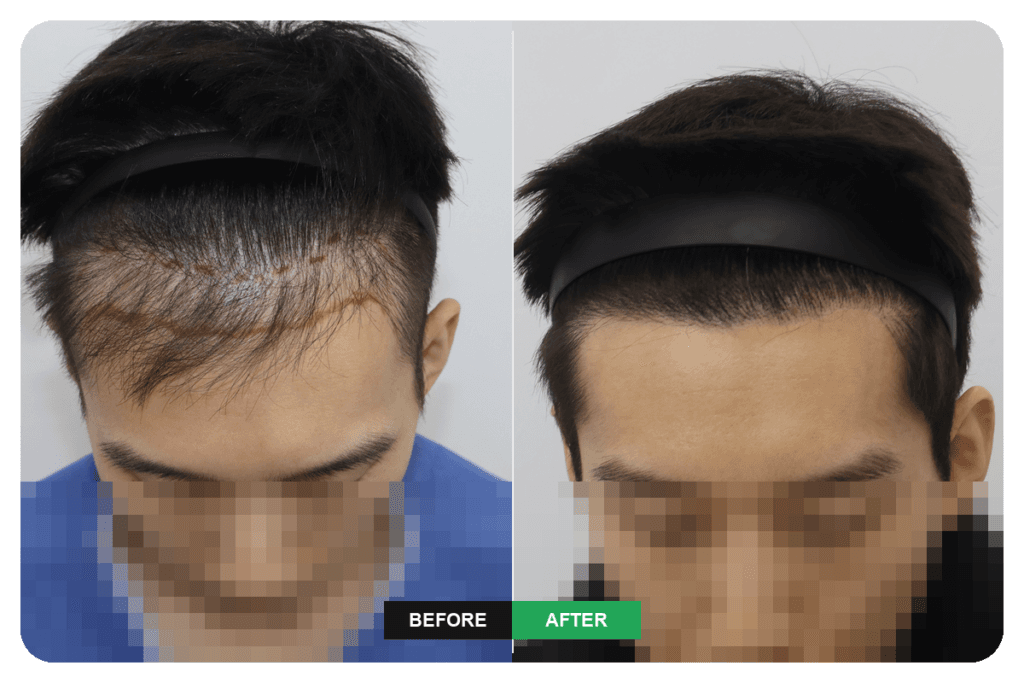 Hairline revision surgery after incision and non-incision hair transplants