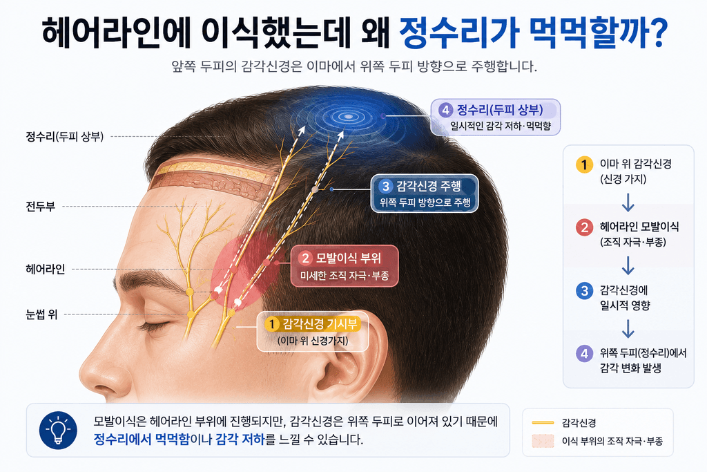 헤어라인 모발이식 후 정수리 감각 저하가 나타나는 신경 구조