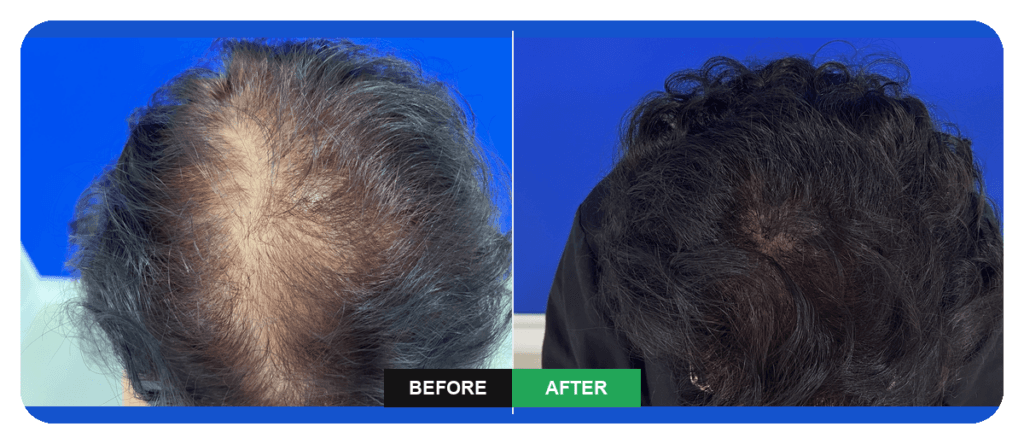 Improved crown density after hair follicle stem cell treatment