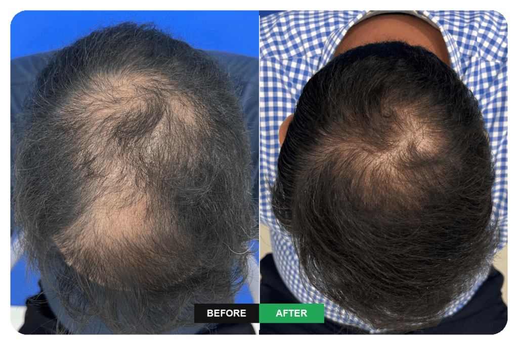 Crown hair transplant revision surgery and stem cell treatment