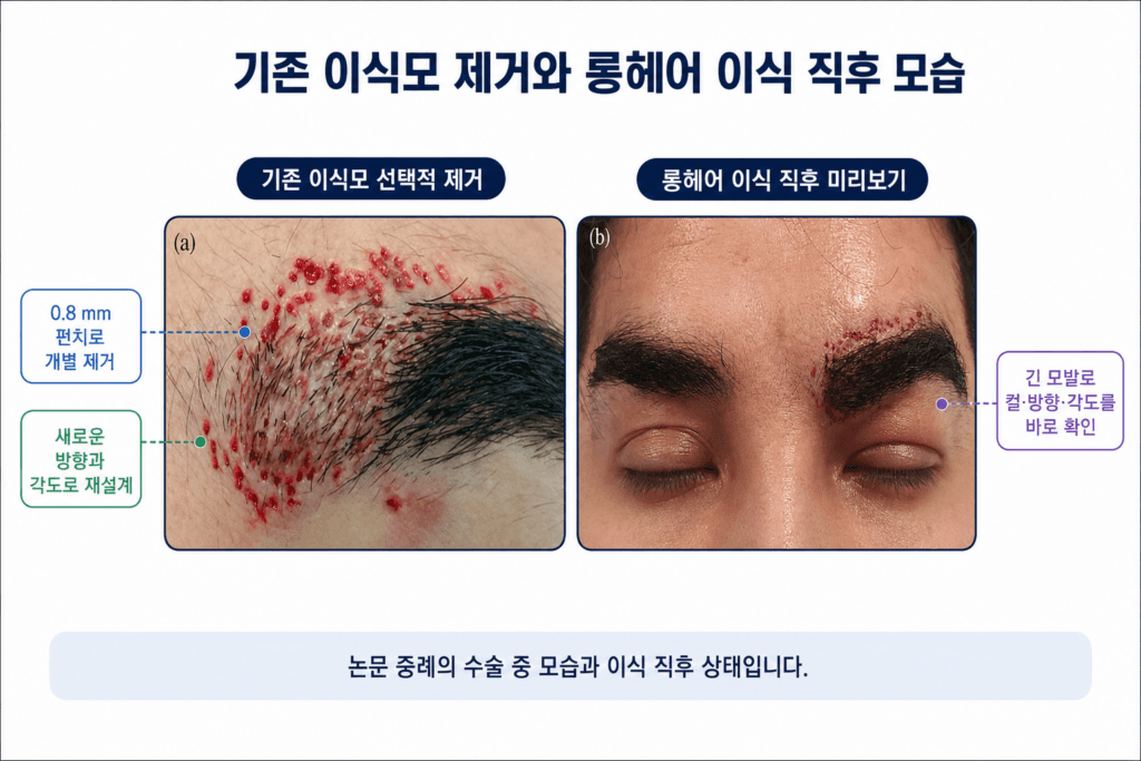 0.8mm 펀치로 기존 눈썹 이식모를 제거하고 롱헤어로 재이식한 논문 증례