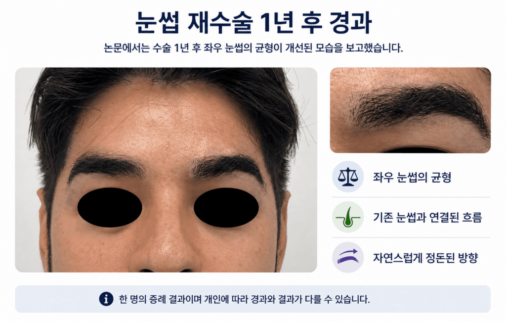 프리뷰 롱헤어 FUE 눈썹 재수술 1년 후 논문 증례