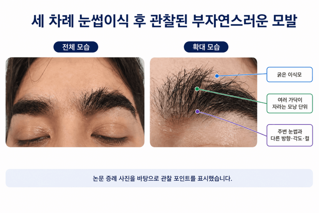 눈썹이식 후 굵은 이식모와 다모낭, 방향과 각도가 어긋난 논문 증례