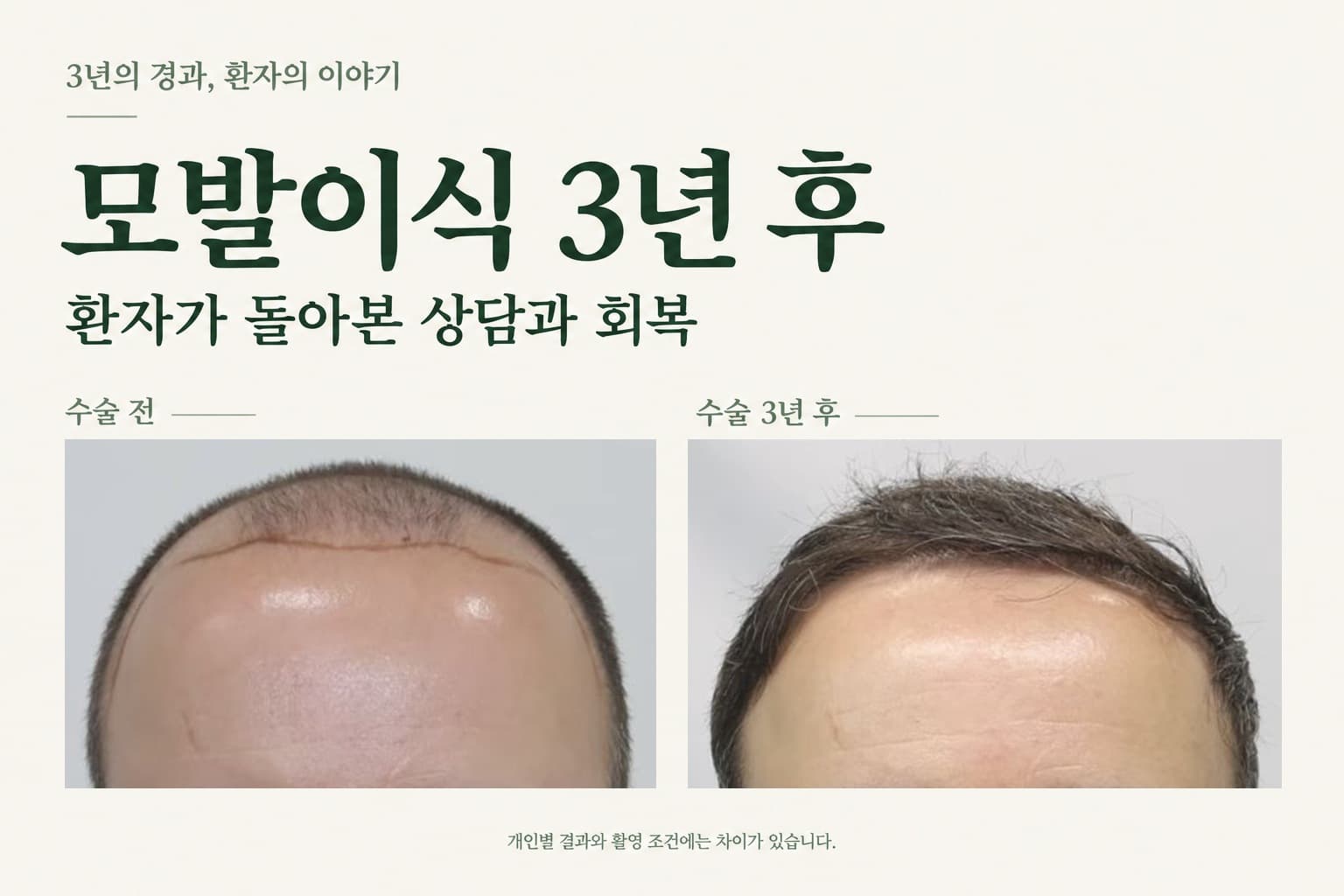 모발이식 3년 후, 환자가 기억하는 상담과 수술 후 관리